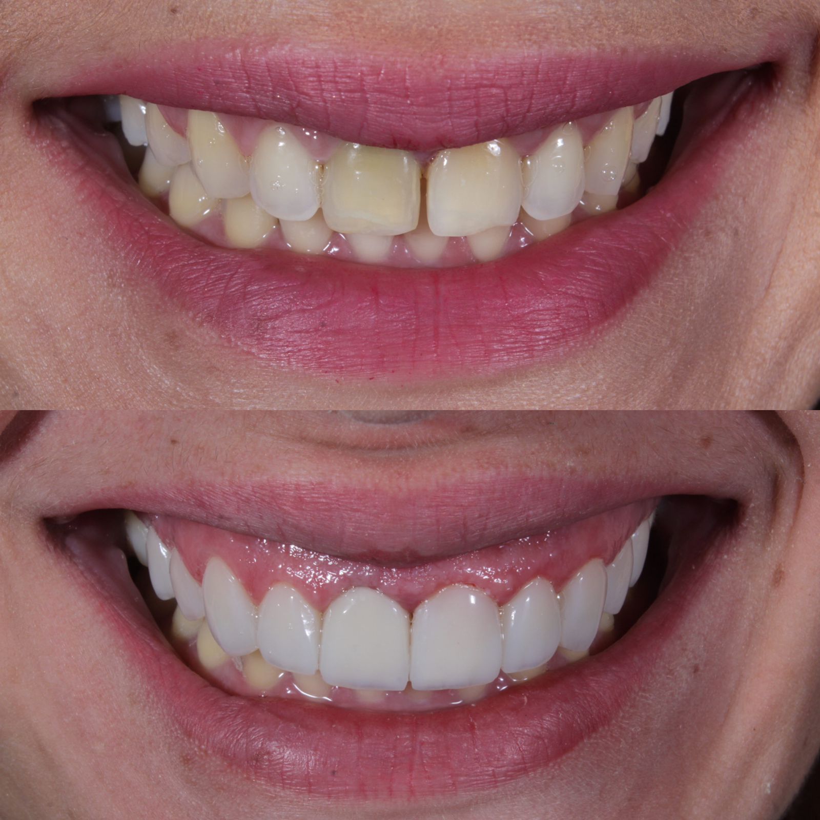 facetas antes x depois.jpg